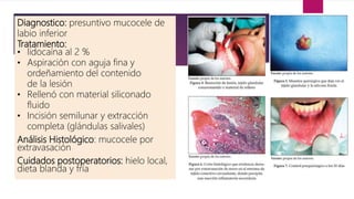 Diagnostico: presuntivo mucocele de
labio inferior
Tratamiento:
• lidocaína al 2 %
• Aspiración con aguja fina y
ordeñamiento del contenido
de la lesión
• Rellenó con material siliconado
fluido
• Incisión semilunar y extracción
completa (glándulas salivales)
Análisis Histológico: mucocele por
extravasación
Cuidados postoperatorios: hielo local,
dieta blanda y fría
 