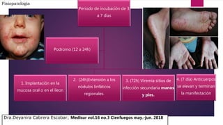 Fisiopatología
Periodo de incubación de 3
a 7 días
1. Implantación en la
mucosa oral o en el íleon
2. (24h)Extensión a los
nódulos linfáticos
regionales.
3. (72h) Viremia sitios de
infección secundaria manos
y pies.
Podromo (12 a 24h)
4. (7 día) Anticuerpos
se elevan y terminan
la manifestación
Dra.Deyanira Cabrera Escobar; Medisur vol.16 no.3 Cienfuegos may.-jun. 2018
 