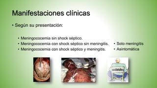 Manifestaciones clínicas
• Según su presentación:
• Meningococemia sin shock séptico.
• Meningococemia con shock séptico sin meningitis.
• Meningococemia con shock séptico y meningitis.
 