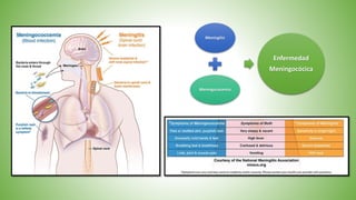 Meningitis
Meningococemia
Enfermedad
Meningocócica
 