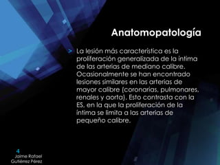 4
Jaime Rafael
Gutiérrez Pérez
Jaime Rafael
Gutiérrez Pérez
Anatomopatología
> La lesión más característica es la
proliferación generalizada de la íntima
de las arterias de mediano calibre.
Ocasionalmente se han encontrado
lesiones similares en las arterias de
mayor calibre (coronarias, pulmonares,
renales y aorta). Esto contrasta con la
ES, en la que la proliferación de la
íntima se limita a las arterias de
pequeño calibre.
 