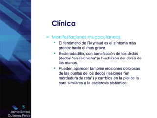 Clínica
> Manifestaciones mucocutaneas
• El fenómeno de Raynaud es el síntoma más
precoz hasta el mas grave.
• Esclerodactilia, con tumefacción de los dedos
(dedos "en salchicha")e hinchazón del dorso de
las manos.
• Pueden aparecer también erosiones dolorosas
de las puntas de los dedos (lesiones "en
mordedura de rata") y cambios en la piel de la
cara similares a la esclerosis sistémica.
5
Jaime Rafael
Gutiérrez Pérez
 