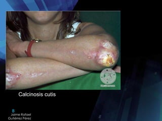 8
Jaime Rafael
Gutiérrez Pérez
Calcinosis cutis
 