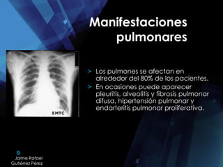 9
Jaime Rafael
Gutiérrez Pérez
Jaime Rafael
Gutiérrez Pérez
Manifestaciones
pulmonares
> Los pulmones se afectan en
alrededor del 80% de los pacientes.
> En ocasiones puede aparecer
pleuritis, alveolitis y fibrosis pulmonar
difusa, hipertensión pulmonar y
endarteritis pulmonar proliferativa.
 