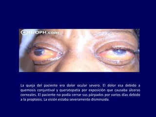 La queja del paciente era dolor ocular severo. El dolor esa debido a
quemosis conjuntival y queratopatía por exposición que causaba úlceras
corneales. El paciente no podía cerrar sus párpados por varios días debido
a la proptosis. La visión estaba severamente disminuida.
 