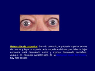 Retracción de párpados: Sería lo contrario, el párpado superior en vez
de caerse y tapar una parte de la superficie del ojo que debería dejar
expuesta, está demasiado arriba y expone demasiada superficie.
Aunque es bastante característico de la afectación ocular del tiroides,
hay más causas
 