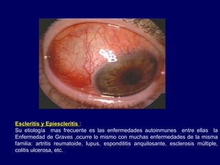 Escleritis y Epiescleritis :
Su etiología mas frecuente es las enfermedades autoinmunes entre ellas la
Enfermedad de Graves ,ocurre lo mismo con muchas enfermedades de la misma
familia: artritis reumatoide, lupus, espondilitis anquilosante, esclerosis múltiple,
colitis ulcerosa, etc.
 