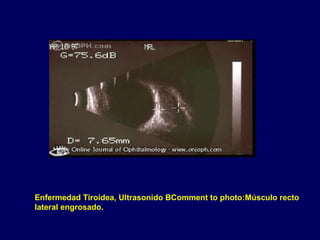 Enfermedad Tiroidea, Ultrasonido BComment to photo:Músculo recto
lateral engrosado.
 