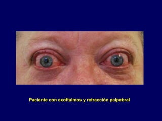 Paciente con exoftalmos y retracción palpebral
 