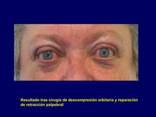 Resultado tras cirugía de descompresión orbitaria y reparación
de retracción palpebral
 