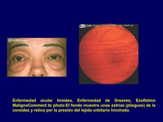 Enfermedad ocular tiroidea, Enfermedad de Greaves, Exoftalmo
MalignoComment to photo:El fondo muestra unas estrías (pliegues) de la
coroides y retina por la presión del tejido orbitario hinchado.
 