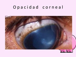 Opacidad corneal

 