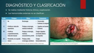 DIAGNÓSTICO Y CLASIFICACIÓN
 Se realiza mediante historia clínica y exploración.
 Las hemorroides externas no se clasifican.
 