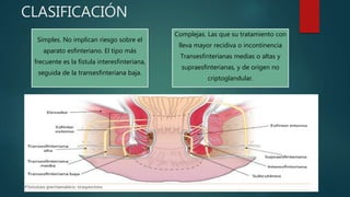 CLASIFICACIÓN
Simples. No implican riesgo sobre el
aparato esfinteriano. El tipo más
frecuente es la fístula interesfinteriana,
seguida de la transesfinteriana baja.
Complejas. Las que su tratamiento con
lleva mayor recidiva o incontinencia
Transesfinterianas medias o altas y
supraesfinterianas, y de origen no
criptoglandular.
 