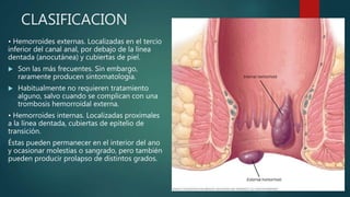 CLASIFICACION
• Hemorroides externas. Localizadas en el tercio
inferior del canal anal, por debajo de la línea
dentada (anocutánea) y cubiertas de piel.
 Son las más frecuentes. Sin embargo,
raramente producen sintomatología.
 Habitualmente no requieren tratamiento
alguno, salvo cuando se complican con una
trombosis hemorroidal externa.
• Hemorroides internas. Localizadas proximales
a la línea dentada, cubiertas de epitelio de
transición.
Éstas pueden permanecer en el interior del ano
y ocasionar molestias o sangrado, pero también
pueden producir prolapso de distintos grados.
 