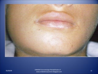 UNMSM Estomatologia Rehabilitadora II  www.endodonciaunmsm.blogspot.com 06/10/09 