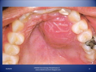 UNMSM Estomatologia Rehabilitadora II  www.endodonciaunmsm.blogspot.com 06/10/09 