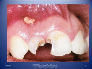 UNMSM Estomatologia Rehabilitadora II  www.endodonciaunmsm.blogspot.com 06/10/09 