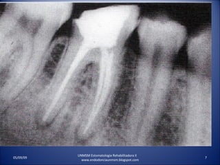 UNMSM Estomatologia Rehabilitadora II  www.endodonciaunmsm.blogspot.com 06/10/09 