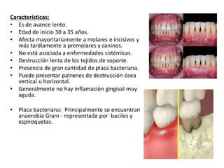 Características:
• Es de avance lento.
• Edad de inicio 30 a 35 años.
• Afecta mayoritariamente a molares e incisivos y
más tardíamente a premolares y caninos.
• No está asociada a enfermedades sistémicas.
• Destrucción lenta de los tejidos de soporte.
• Presencia de gran cantidad de placa bacteriana.
• Puede presentar patrones de destrucción ósea
vertical u horizontal.
• Generalmente no hay inflamación gingival muy
aguda.
• Placa bacteriana: Principalmente se encuentran
anaerobia Gram - representada por bacilos y
espiroquetas.
 