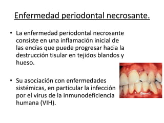 Enfermedad periodontal necrosante.
• La enfermedad periodontal necrosante
consiste en una inflamación inicial de
las encías que puede progresar hacia la
destrucción tisular en tejidos blandos y
hueso.
• Su asociación con enfermedades
sistémicas, en particular la infección
por el virus de la inmunodeficiencia
humana (VIH).
 