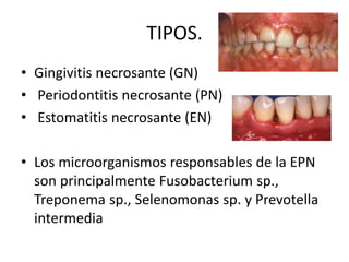 TIPOS.
• Gingivitis necrosante (GN)
• Periodontitis necrosante (PN)
• Estomatitis necrosante (EN)
• Los microorganismos responsables de la EPN
son principalmente Fusobacterium sp.,
Treponema sp., Selenomonas sp. y Prevotella
intermedia
 