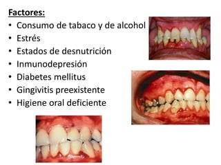 Factores:
• Consumo de tabaco y de alcohol
• Estrés
• Estados de desnutrición
• Inmunodepresión
• Diabetes mellitus
• Gingivitis preexistente
• Higiene oral deficiente
 