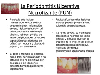 La Periodontitis Ulcerativa
Necrotizante (PUN)
• Patología que incluye
manifestaciones como dolor
agudo e intenso, inflamación
severa, rápida destrucción del
tejido, abundante hemorragia
gingival, halitosis, perdida de
inserción gingival, en ocasiones
exposición ósea (lesiones en
cráter) por necrosis y ulceración
papilar y del periodonto.
• El dolor a menudo se describe
como dolor dental profundo ó en
el hueso que no disminuye con
analgésico, en ocasiones
presenta hemorragia nocturna
espontánea.
• Radiográficamente las lesiones
iniciales pueden presentar o no
evidencia de perdida ósea.
• La forma severa, se manifiesta
con extensa necrosis del tejido
gingival y el hueso alveolar, se
propaga de la unión mucogingival
con pérdida ósea significativa,
movilidad dental que
generalmente ocasiona su pérdida
 