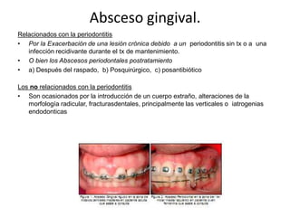 Absceso gingival.
Relacionados con la periodontitis
• Por la Exacerbación de una lesión crónica debido a un periodontitis sin tx o a una
infección recidivante durante el tx de mantenimiento.
• O bien los Abscesos periodontales postratamiento
• a) Después del raspado, b) Posquirúrgico, c) posantibiótico
Los no relacionados con la periodontitis
• Son ocasionados por la introducción de un cuerpo extraño, alteraciones de la
morfología radicular, fracturasdentales, principalmente las verticales o iatrogenias
endodonticas
 