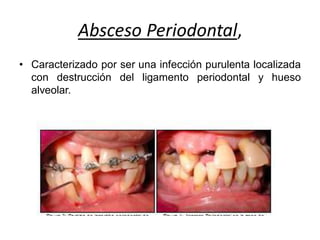 Absceso Periodontal,
• Caracterizado por ser una infección purulenta localizada
con destrucción del ligamento periodontal y hueso
alveolar.
 