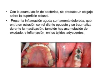 • Con la acumulación de bacterias, se produce un colgajo
sobre la superficie oclusal.
• Presenta inflamación aguda sumamente dolorosa, que
entra en oclusión con el diente opuesto y se traumatiza
durante la masticación, también hay acumulación de
exudado, e inflamación en los tejidos adyacentes.
 