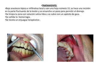 •TRATAMIENTO.
•Bajo anestesia tópica e infiltrativa local y con una hoja número 15, se hace una incisión
en la parte fluctuante de la lesión y se ensancha un poco para permitir el drenaje.
•Se limpia la zona con solución salina tibia y se cubre con un apósito de gasa.
•Se cohíbe la hemorragia .
•Se receta un enjuague terapéutico .
 