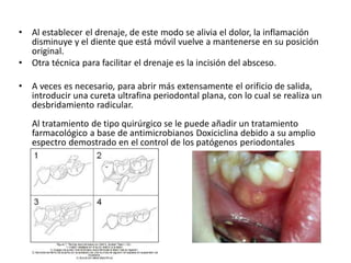 • Al establecer el drenaje, de este modo se alivia el dolor, la inflamación
disminuye y el diente que está móvil vuelve a mantenerse en su posición
original.
• Otra técnica para facilitar el drenaje es la incisión del absceso.
• A veces es necesario, para abrir más extensamente el orificio de salida,
introducir una cureta ultrafina periodontal plana, con lo cual se realiza un
desbridamiento radicular.
Al tratamiento de tipo quirúrgico se le puede añadir un tratamiento
farmacológico a base de antimicrobianos Doxiciclina debido a su amplio
espectro demostrado en el control de los patógenos periodontales
 
