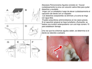 Abscesos Pericoronarios Agudos consiste en: 1)Lavar
cuidadosamente la zona con solución salina tibia para quitar
desechos y exudado.
Irrigar con un antiséptico luego de elevar cuidadosamente el
capuchón del diente con un raspador.
Los desechos subyacentes se eliminan y la zona se irriga
con agua tibia.
Pueden prescribirse antimicrobianos en los casos graves.
Si el capuchón gingival se haya tumefacto y fluctuante, se
realiza una incisión anteroposterior con una hoja número 15
para establecer drenaje.
Una vez que los síntomas agudos ceden, se determina si el
diente se retendrá o extraerá.
 