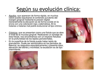 Según su evolución clínica:
• Agudos, que aparecen de forma rápida, en muchos
casos puede expulsarse el contenido purulento del
margen gingival mediante la presión digital.
Generalmente la elevación es de forma ovoide en la
encía con una coloración roja y edematosa. Al no
tratarse o tratarse mal podrá evolucionar al tipo crónico.
• Crónicos, que se presentan como una fístula que se abre
a nivel de la mucosa gingival. Realizando un sondaje de
esta fístula, nos encontramos con un trayecto fistuloso
en la profundidad de los tejidos periodontales.
• En la superficie de la fístula puede haber tejido de
granulación. Suele ser asintomático en los períodos de
latencia; se reagudiza esporádicamente y presenta dolor,
elevación del diente y movilidad, la exudación es de tipo
intermitente.
 