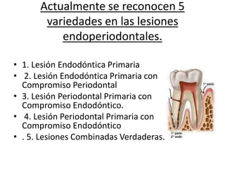 Actualmente se reconocen 5
variedades en las lesiones
endoperiodontales.
• 1. Lesión Endodóntica Primaria
• 2. Lesión Endodóntica Primaria con
Compromiso Periodontal
• 3. Lesión Periodontal Primaria con
Compromiso Endodóntico.
• 4. Lesión Periodontal Primaria con
Compromiso Endodóntico
• . 5. Lesiones Combinadas Verdaderas.
 
