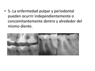 • 5-.La enfermedad pulpar y periodontal
pueden ocurrir independientemente o
concomitantemente dentro y alrededor del
mismo diente.
 