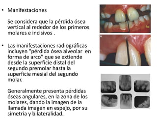 • Manifestaciones
Se considera que la pérdida ósea
vertical al rededor de los primeros
molares e incisivos .
• Las manifestaciones radiográficas
incluyen "pérdida ósea alveolar en
forma de arco” que se extiende
desde la superficie distal del
segundo premolar hasta la
superficie mesial del segundo
molar.
Generalmente presenta pérdidas
óseas angulares, en la zona de los
molares, dando la imagen de la
llamada imagen en espejo, por su
simetría y bilateralidad.
 