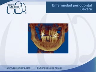 www.dentometric.com Dr. Enrique Sierra Rosales
Enfermedad periodontal
Severa
 