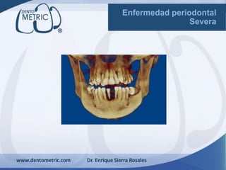 www.dentometric.com Dr. Enrique Sierra Rosales
Enfermedad periodontal
Severa
 