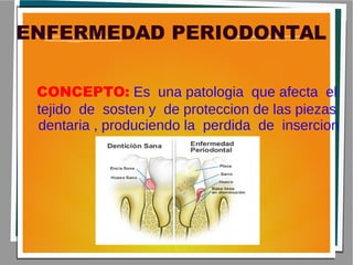 ENFERMEDAD PERIODONTAL
CONCEPTO: Es una patologia que afecta el
tejido de sosten y de proteccion de las piezas
dentaria , produciendo la perdida de insercion
 