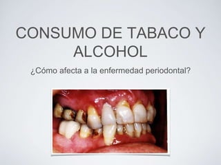 CONSUMO DE TABACO Y
ALCOHOL
¿Cómo afecta a la enfermedad periodontal?
 