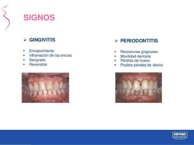 Enfermedad Periodontal Y Embarazo