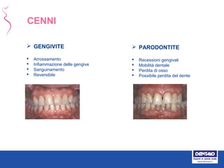  GENGIVITE
 Arrossamento
 Infiammazione delle gengive
 Sanguinamento
 Reversibile
 PARODONTITE
 Recessioni gengivali
 Mobilità dentale
 Perdita di osso
 Possibile perdita del dente
CENNI
 