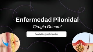Sandy Burgos Cabanillas
Enfermedad Pilonidal
Cirugía General
 