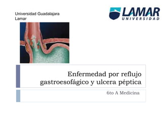 Enfermedad por reflujo
gastroesofágico y ulcera péptica
6to A Medicina
Universidad Guadalajara
Lamar
 