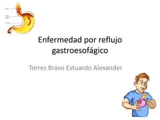 Enfermedad por reflujo
gastroesofágico
Torres Bravo Estuardo Alexander
 