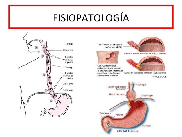 (17.11.2005) - Enfermedad por Reflujo Gastroesofágico (PPT)