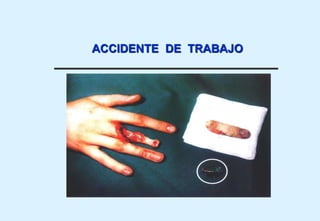 ACCIDENTE DE TRABAJO
 