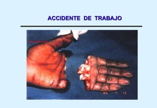 ACCIDENTE DE TRABAJO
 